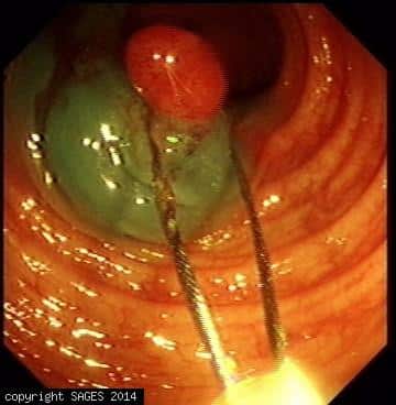 what is a colonoscopy with polypectomy