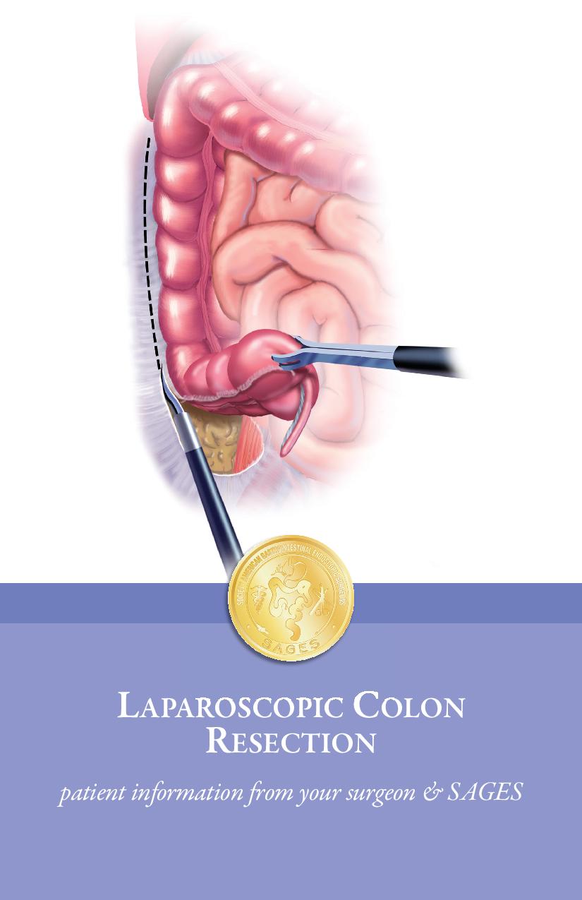 Laparoscopic Colon Resection