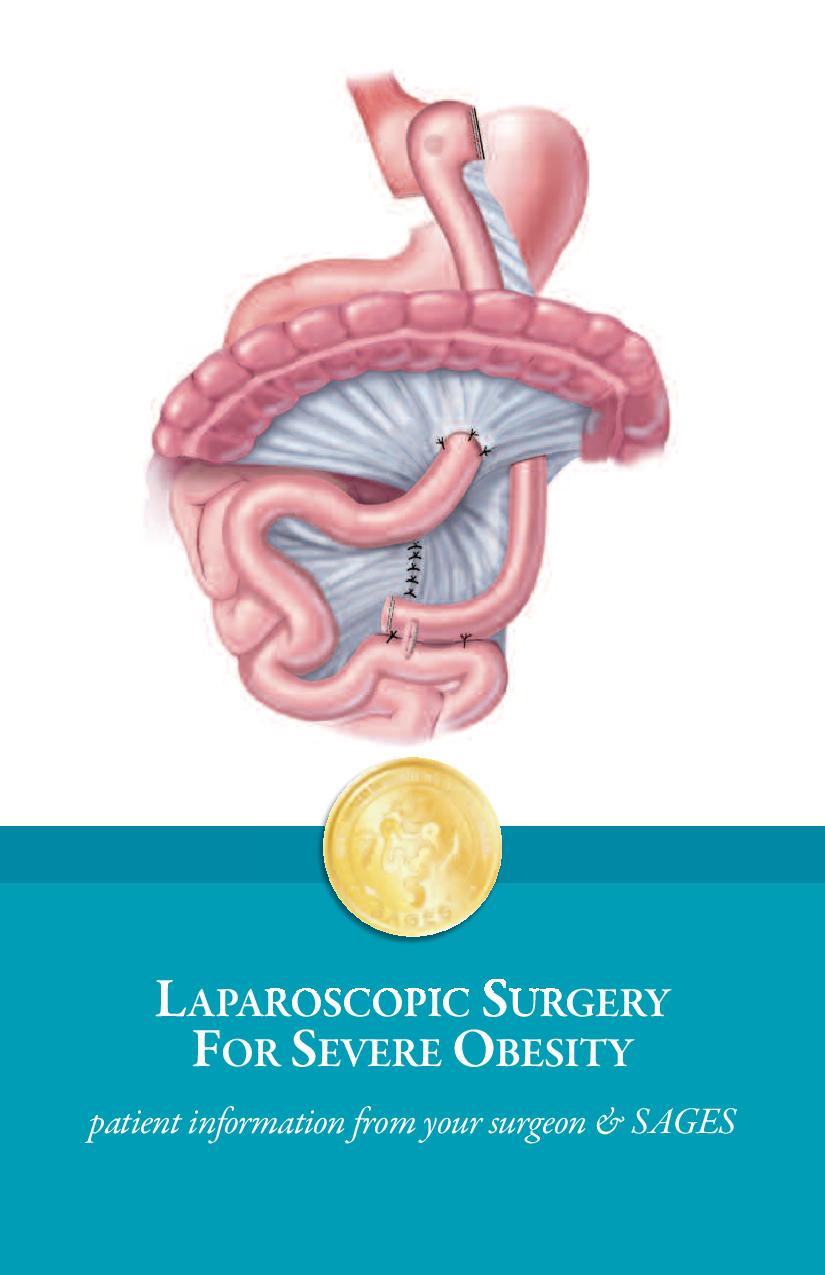 Laparoscopic Surgery for Severe Obesity