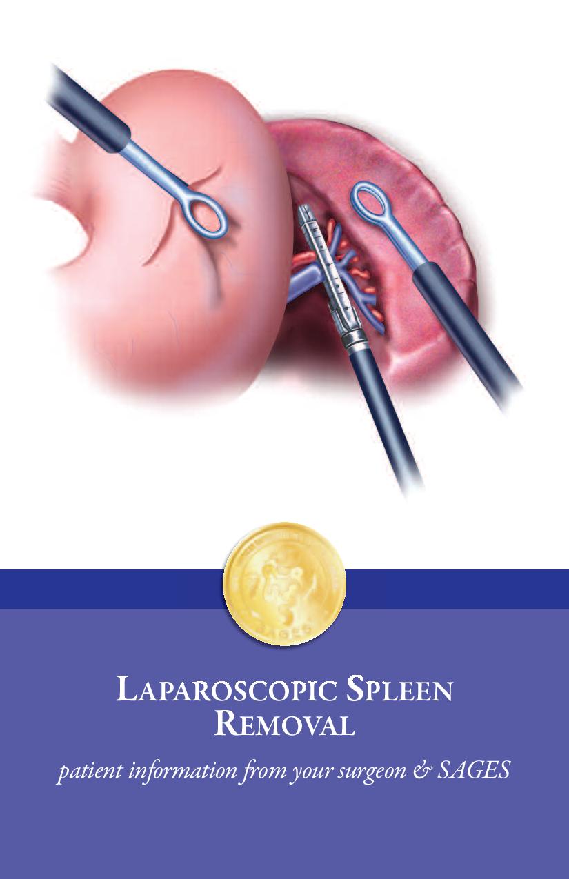 Laparoscopic Spleen Removal
