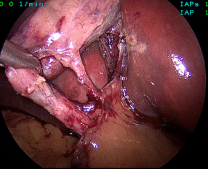 Safe Chole Figure 2A Documentation of the doublet view anterior