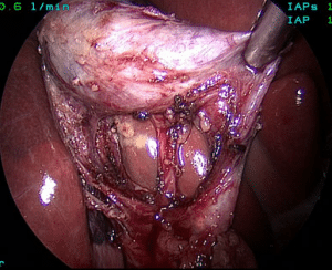 Safe Chole Figure 2B Documentation of the doublet view posterior