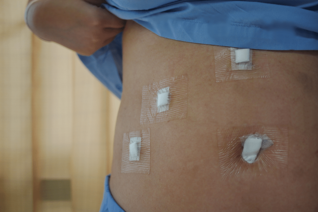 Incisions after minimally invasive (laparoscopic) surgery