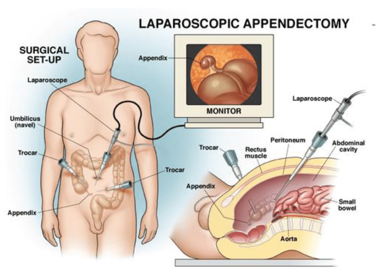 Laparoscopic Appendix Removal (Appendectomy)