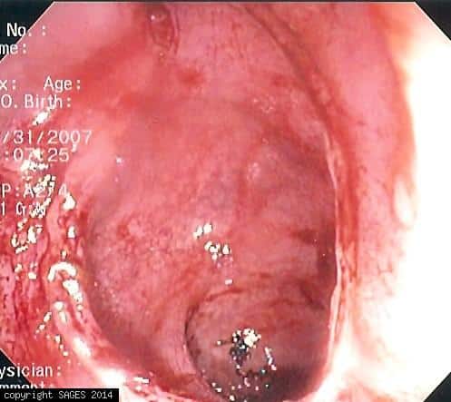 Endoscopic view of EEA anastomosis