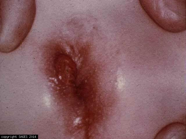 syphilitic ulcer