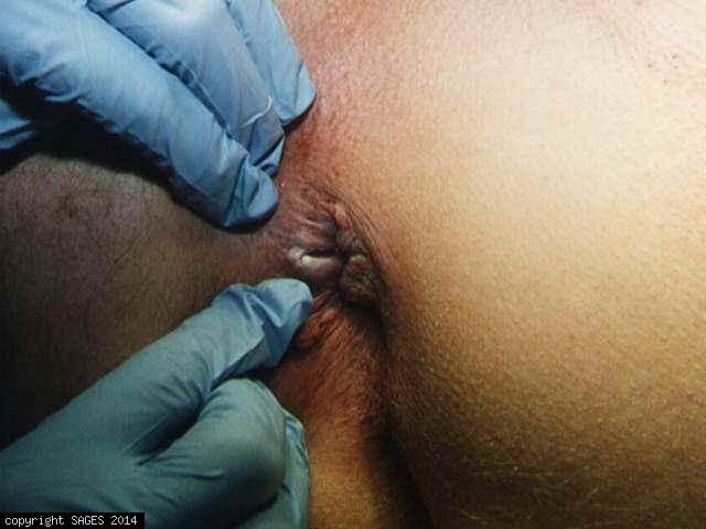 fibrotic chronic anal fissure