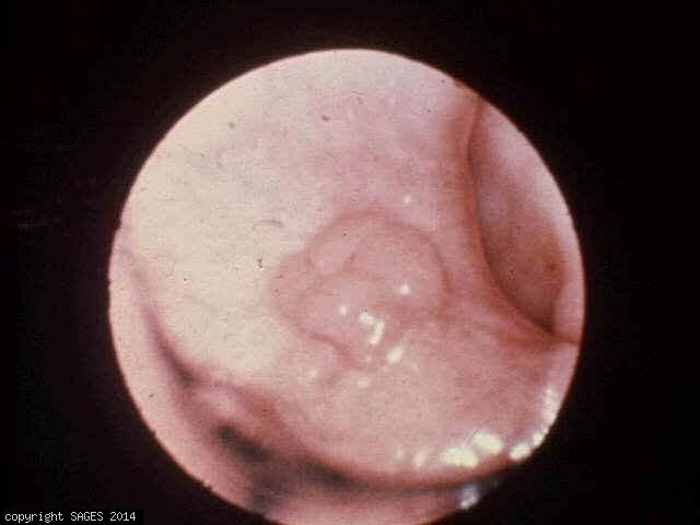 What is a sessile polyp?