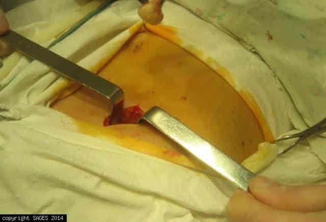 mini-incision opened by two rectors mini-incision opened by two rectors