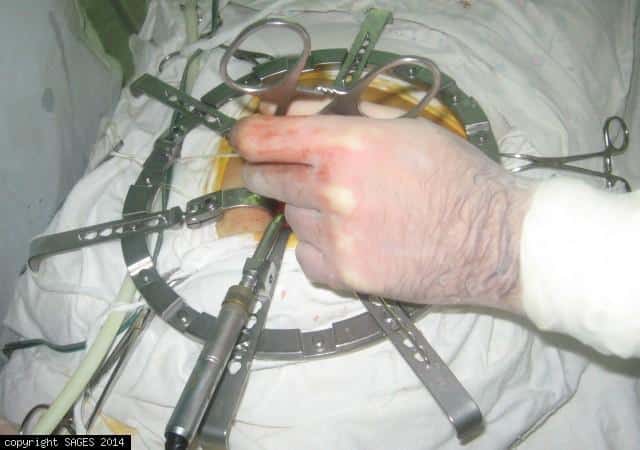 mini-laparotomy mini-laparotomy