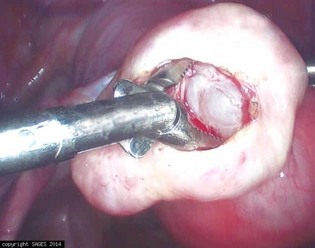 extraction of ovarian cyst