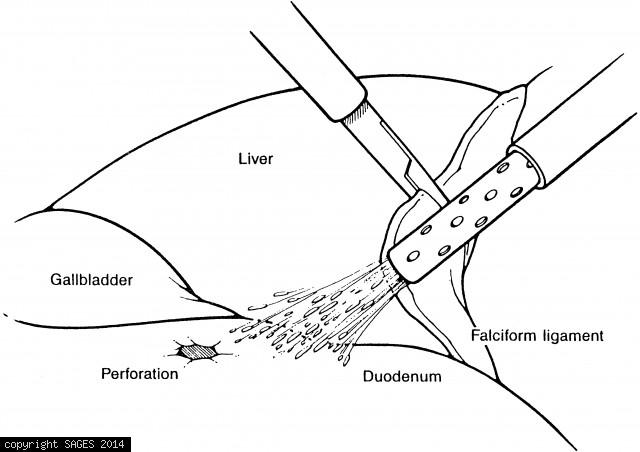 Exposure of typical perforated duodenal ulcer