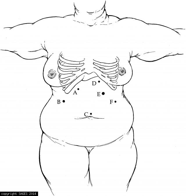Port Placement for Gastric Bypass