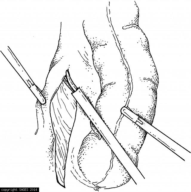 Retracting the peritoneum laterally