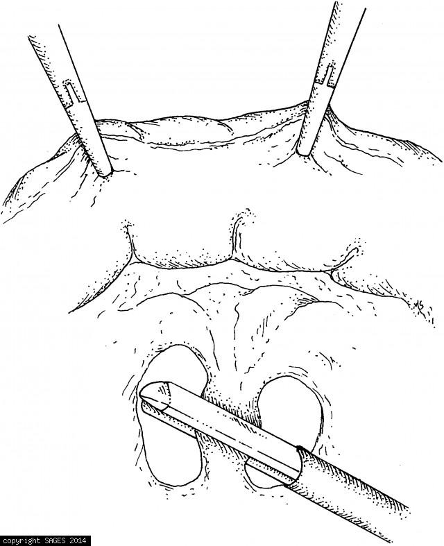 The colon is retracted toward anterior abdominal