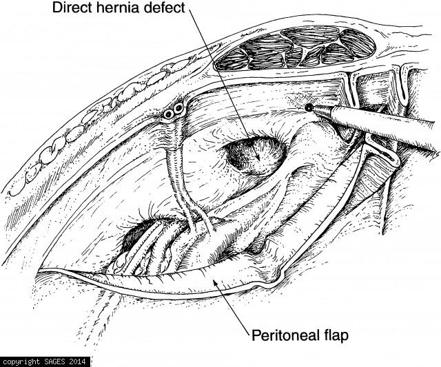 Mobilizing the peritoneal flap