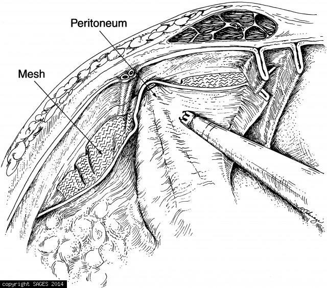 Closing peritoneal flap over the mesh with staples