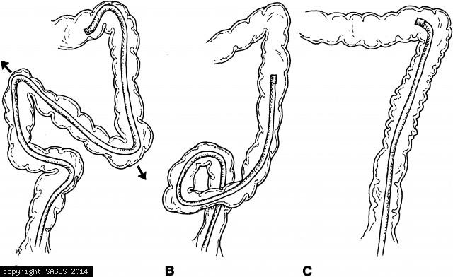 Formation of loops in the colon
