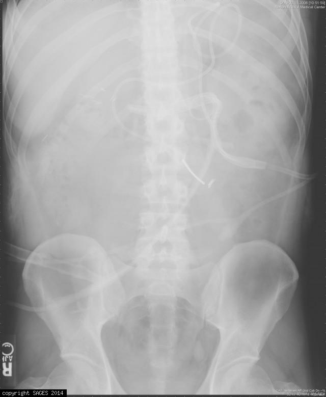 Radiograph of a PEG with J-tube extension