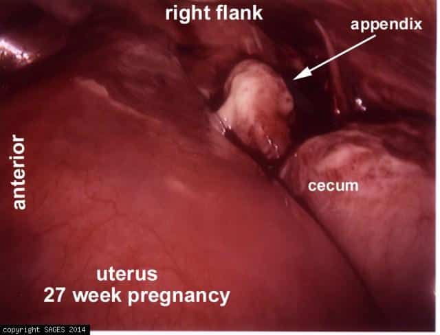 appendicitis in a woman 27 weeks pregnant