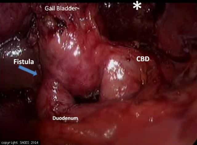 Fundus-down Laparoscopic Cholecystectomy