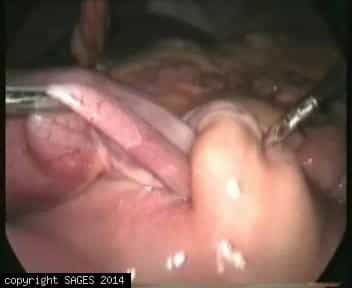 Small bowel obstruction