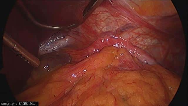 Paraesophageal hernia before reduction