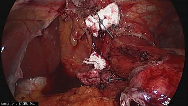 Paraesophageal Hernia – repaired