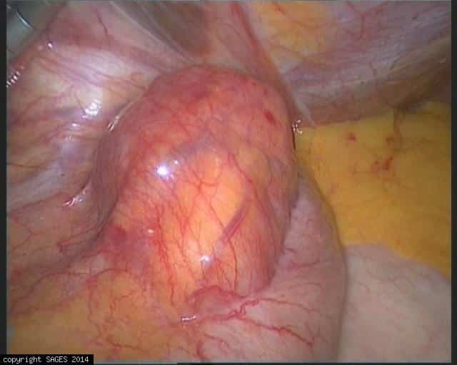 Gastroesophageal Junction GIST tumor
