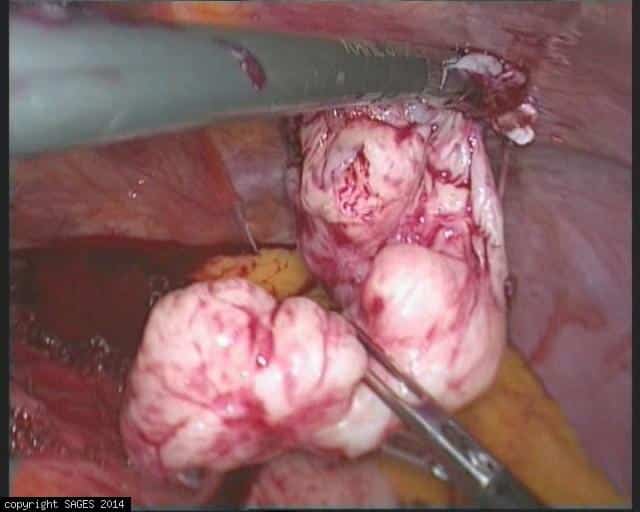 Gastroesophageal Junction GIST tumor