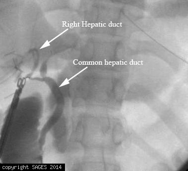 Cystic duct drain into right hepatic duct