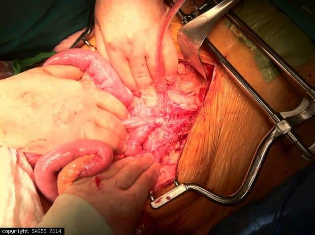 aorto-duodenal fistula