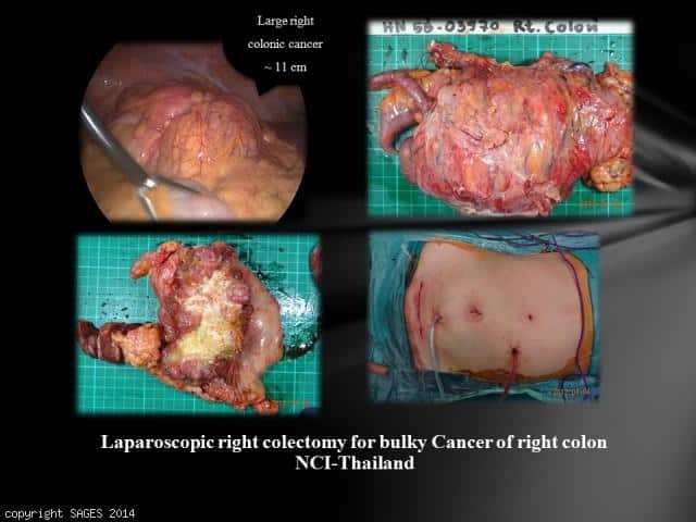 laparoscopic right colectomy for bulky cancer of right colon, NCI Thai
