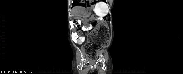 CT scan showing dilated recto-sigmoid