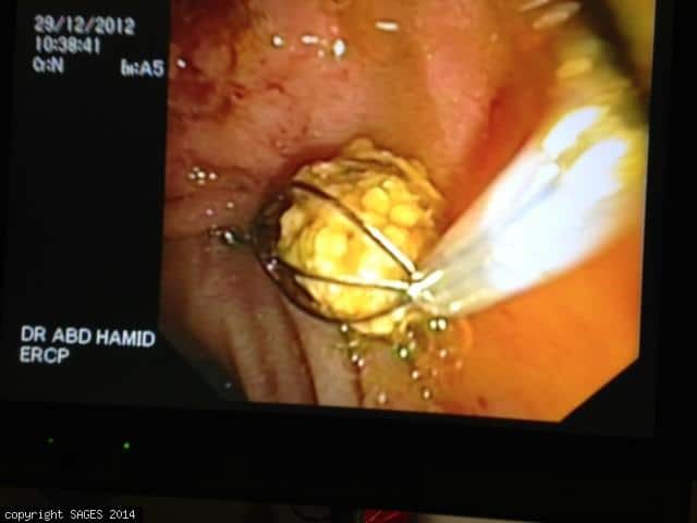Common bile duct stone removed with a Dormia basket