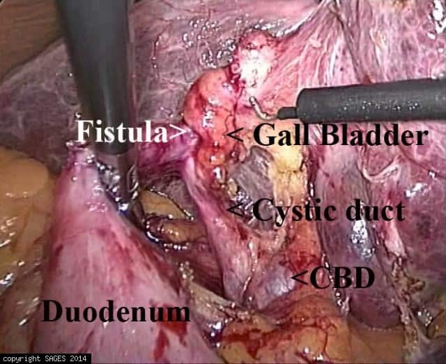 Cholecystoduodenal fistula