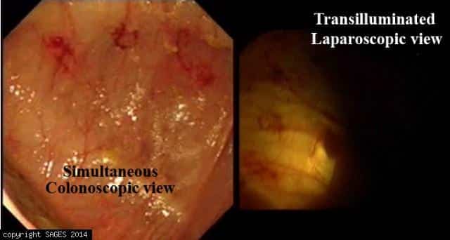 Intraoperative Colonoscopy in Cecum angioectasia