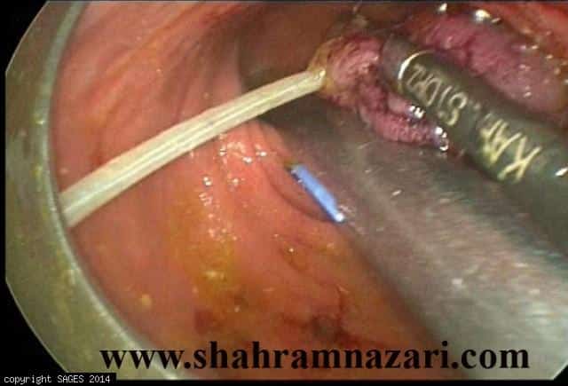 Endoluminal Huge Rectal Polyp Resection by Colonoscopic snare assisted TEO