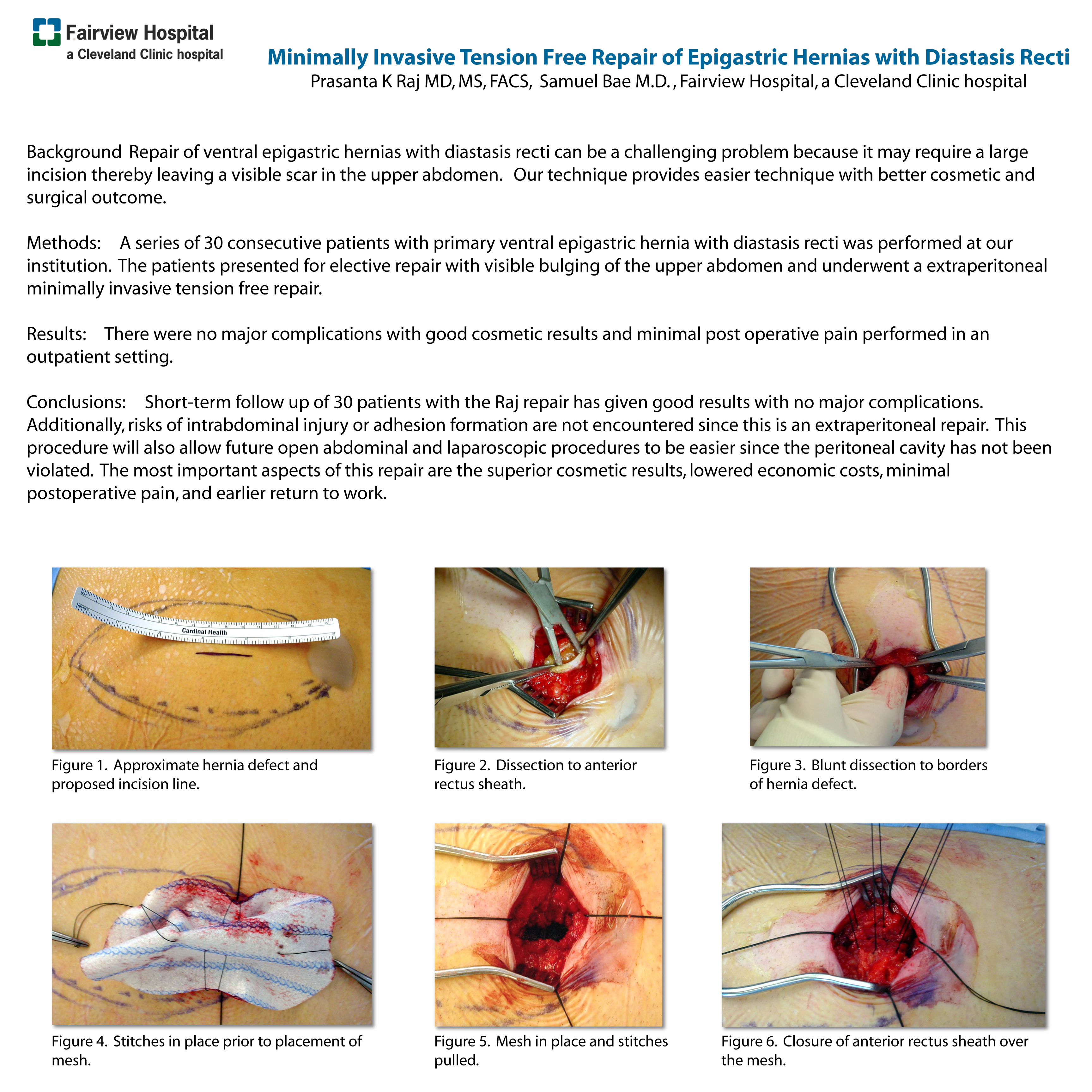 Minimally Invasive Tension Free Repair of Epigastric Hernias with Diastasis  Recti - SAGES Abstract Archives
